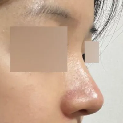 Đã nửa năm kể từ khi phẫu thuật mũi rồi đó hehe