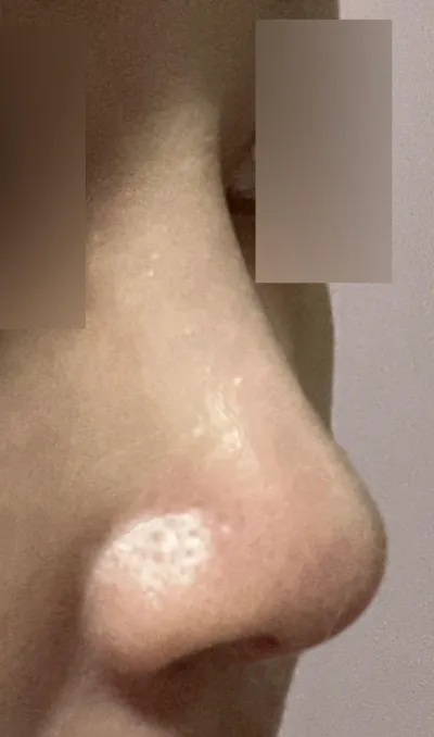 Đã 6 tháng kể từ khi phẫu thuật