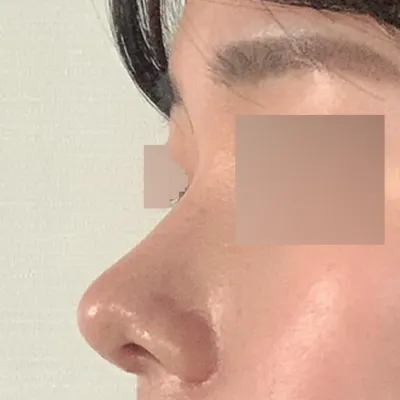 Review sau một tháng phẫu thuật mắt và mũi tại bệnh viện thẩm mỹ Weaver!!