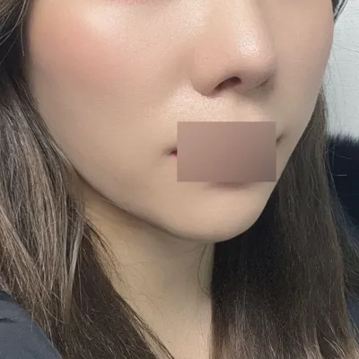 Đã 3 tháng kể từ khi thực hiện căng chỉ Peach