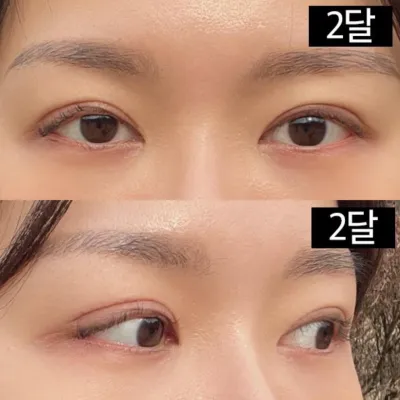 Mình đã phẫu thuật lại mí đôi và chỉnh sửa mắt.