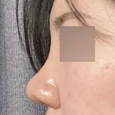 Đánh giá sau 1 tháng phẫu thuật. Mình đã phẫu thuật mũi với bác sĩ Shim Jung Hwan tại bệnh viện thẩm mỹ Wevers!