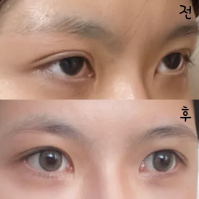 Mình đã tái phẫu thuật mắt tại bệnh viện thẩm mỹ Weavers ở ga Gangnam được hai tháng rồi!