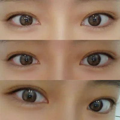 Mình đã thực hiện phẫu thuật mắt không cắt mí với bác sĩ Sim Jung-hwan!