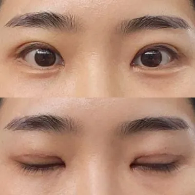 Mình đã phẫu thuật lại mắt được một tuần rồi