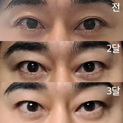 Mình đã phẫu thuật cắt mí mắt kép được 3 tháng.