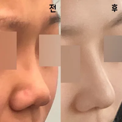 Cuối cùng mình cũng có được chiếc mũi mơ ước của mình!!