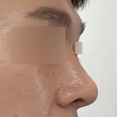 Mình đã phẫu thuật mũi với bác sĩ Seo Seung-jo được 2 tháng.