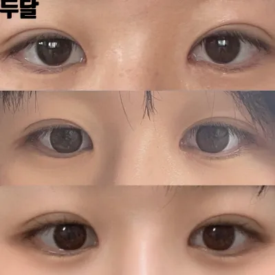 Chia sẻ sau hai tháng phẫu thuật mắt và mũi với bác sĩ Shim Jung-hwan