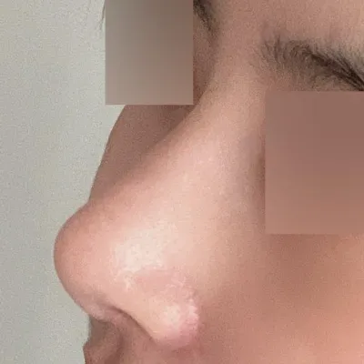 Giờ thì mình nghĩ mình đã hoàn toàn chia tay với chiếc mũi to rồi ㅋㅋ