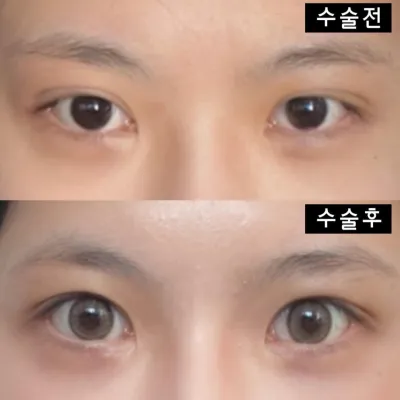 Đã hai tháng kể từ ngày mình phẫu thuật tại bệnh viện thẩm mỹ Weavers ~