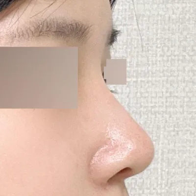 Hôm nay là ngày thứ hai sau phẫu thuật tại Bệnh viện phẫu thuật thẩm mỹ Weavers ~