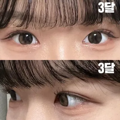 Mình đã phẫu thuật in-out line với bác sĩ Shim Jung Hwan.