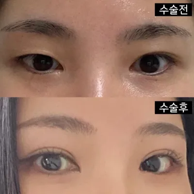 Nếu bạn đang có ý định cắt mí hoặc tái phẫu thuật mắt thì mình rất khuyến khích bạn đến đây