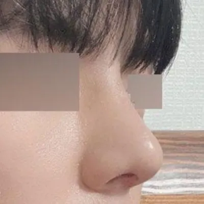 Mình đã phẫu thuật vừa để chữa viêm mũi vừa để chăm sóc bản thân