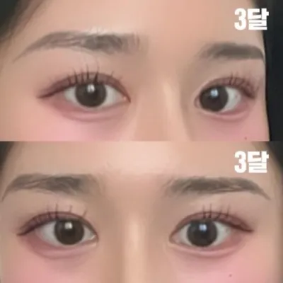 Mình đã phẫu thuật cắt mí được 3 tháng rồi.