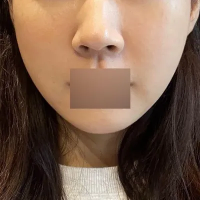 Theo mình, tình trạng này có vẻ không bị sưng nhiều lắm