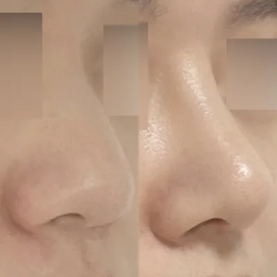 Mình đã phẫu thuật mũi tẹt không dùng chất liệu độn