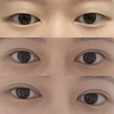 Thành công với đường mí mỏng nhờ cắt mí