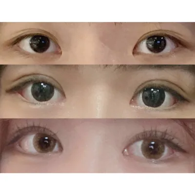 Review hậu phẫu thuật hạ góc mắt dưới + khâu hai mí tự nhiên + chỉnh sửa mắt!