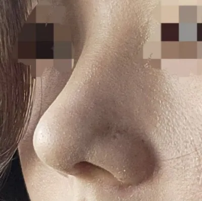 Mình rất hài lòng với kết quả phẫu thuật!