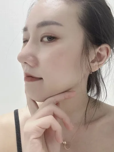 Phẫu thuật thẩm mỹ mũi lần đầu như thế này có phải là thành công không?