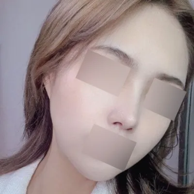 Đánh giá sau 4 tháng nâng cơ + sửa mũi lại