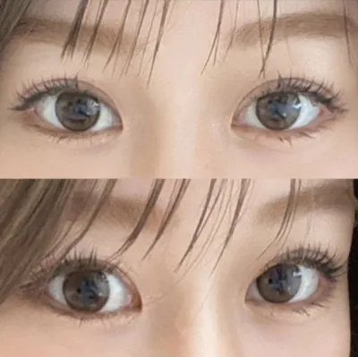 Không có điều trị quá mức và sau khi phẫu thuật cũng chăm sóc rất tốt nữa chứ ㅎㅎㅎ