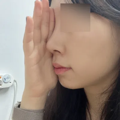 Đánh giá sau 3 tuần phẫu thuật mũi :)