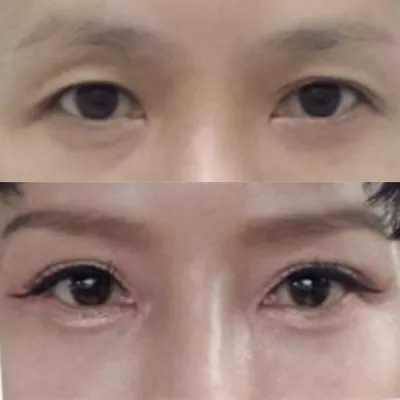 Sưng tấy xẹp nhanh và có vẻ như đã thành công