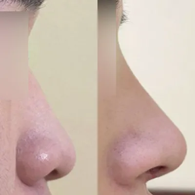 Đánh giá sau phẫu thuật nâng mũi thấp và chảy xệ