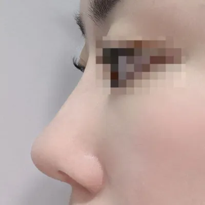 Mình rất thích! Mình rất mong chờ đến khi hết sưng sau một tháng!