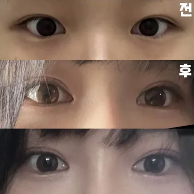 Mình rất hạnh phúc vì kết quả thật thỏa mãn. Cảm ơn bác sĩ!!