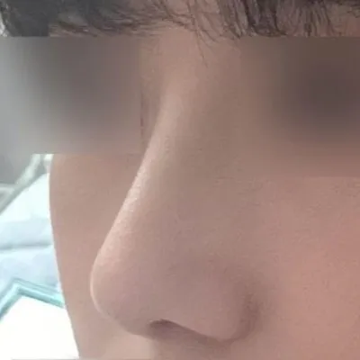 Mặc dù là ca phẫu thuật mũi đầu tiên nhưng mình vẫn vô cùng hài lòng đến 3728299393829%