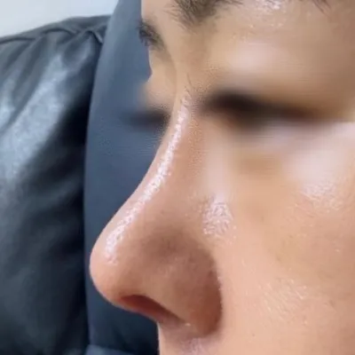 Mình đã lo lắng vì đầu mũi bị xệ xuống, nhưng mình rất vui vì mình đã có đầu mũi ^^