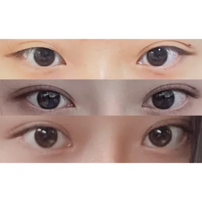 Mình đã phẫu thuật mắt và mũi cùng nhau ㅎㅎ