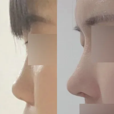 Đã 8 tháng kể từ khi mình phẫu thuật mắt và mũi!