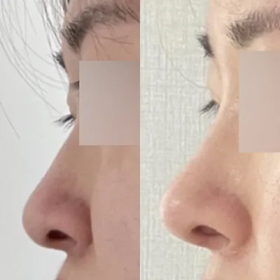 Cuối cùng mình đã phẫu thuật chiếc mũi từng là mặc cảm lâu năm của mình ~