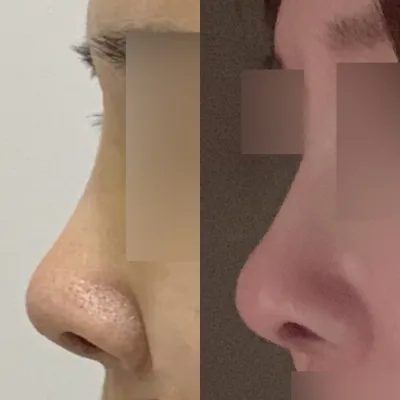 Mình đã phẫu thuật mũi một cách bất ngờ 5 năm trước :-)))