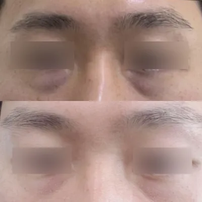 Đánh giá sau 2 tháng tái tạo mỡ dưới mắt :)