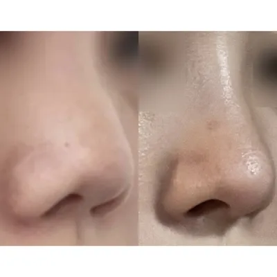 Mình đã phẫu thuật mũi được hơn một tháng rồi!