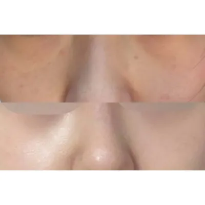 Mình đã phẫu thuật tái tạo mỡ dưới mắt với bác sĩ Sim Jung Hwan!