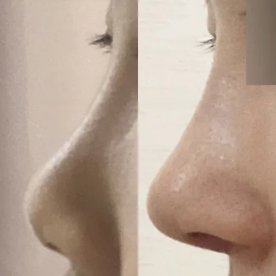 Mình đã phẫu thuật với bác sĩ Shim Jung Hwan được 2 tuần rồi