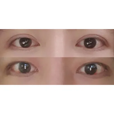 10 ngày sau phẫu thuật thu nhỏ mắt hai mí và chỉnh sửa mắt cho nam giới