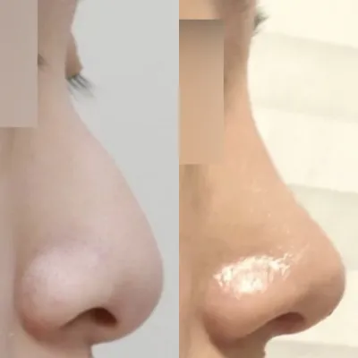 Mình đã phẫu thuật mũi lần đầu tiên không dùng chất liệu độn!