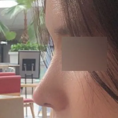 Mình đã phẫu thuật sửa mũi gồ ghề