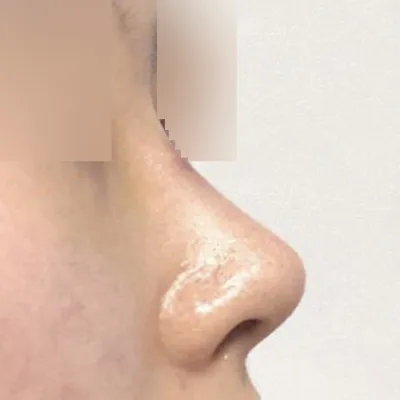 Mình đã phẫu thuật thu nhỏ đầu mũi bị chảy xệ