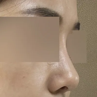 Bài đánh giá sau hơn 3 tháng phẫu thuật~