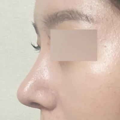 Đã 2 tuần kể từ khi phẫu thuật mũi tẹt