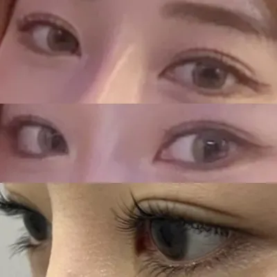 Đã được 1 tháng kể từ khi mình phẫu thuật mắt~~